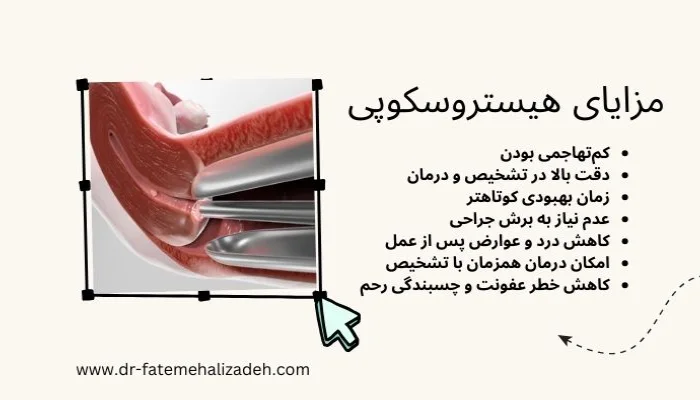 مزایای هیستروسکوپی