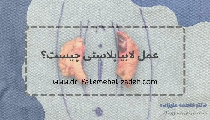 عمل لابیاپلاستی چیست؟