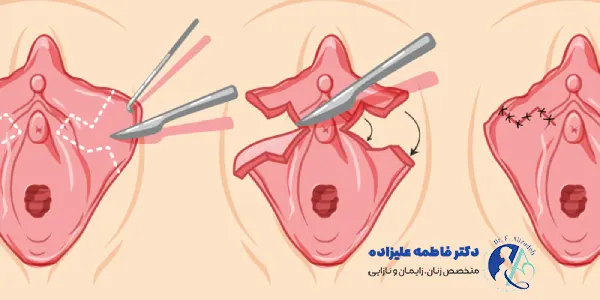 سن مناسب برای لابیاپلاستی