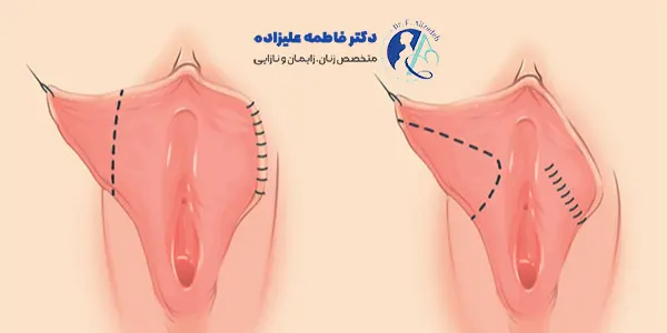 سن مناسب برای لابیاپلاستی