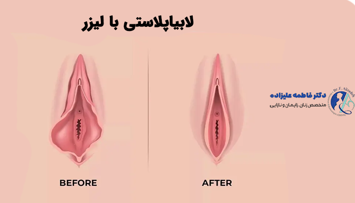 لابیاپلاستی با لیزر چیست