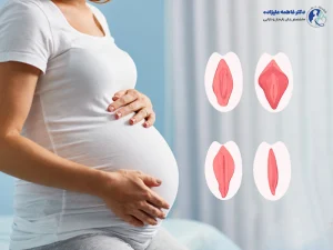 لابیاپلاستی در بارداری