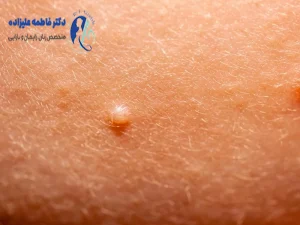 درمان اچ پی وی