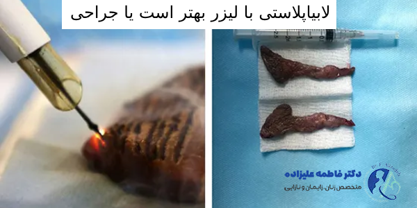 لابیاپلاستی با لیزر بهتر است یا جراحی
