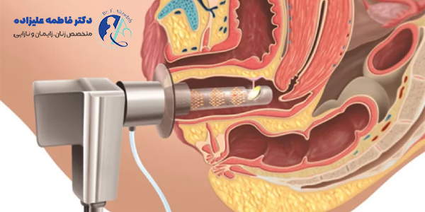 واژینوپلاستی