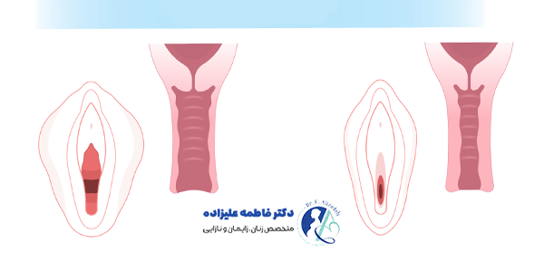 واژینوپلاستی چگونه است