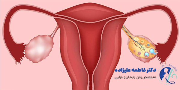 تنبلی تخمدان