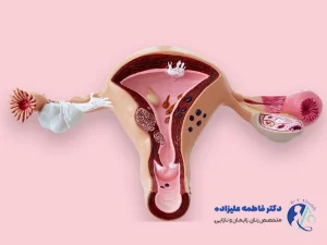 تنبلی تخمدان