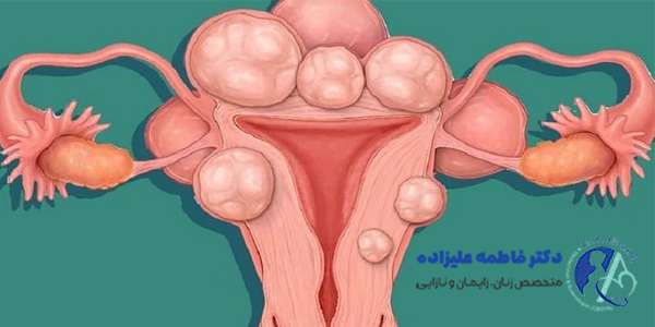 فیبروم رحم در بارداری