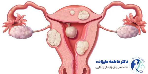 فیبروم رحم در بارداری