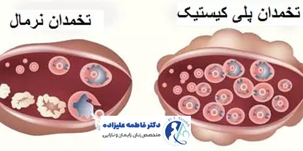سندروم تخمدان پلی کیستیک