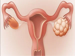 سندروم تخمدان پلی کیستیک