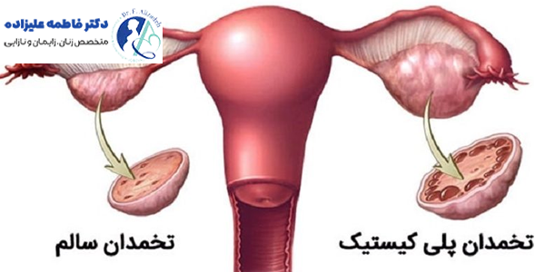 سندروم تخمدان پلی کیستیک