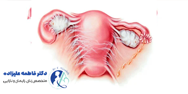 چسبندگی رحم