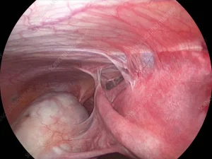 چسبندگی رحم