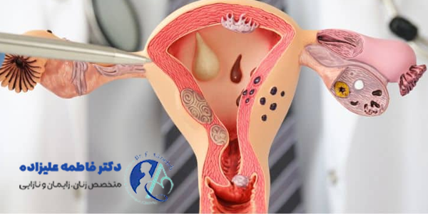 کیست بارتولن در زنان