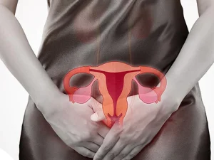 کیست بارتولن در زنان