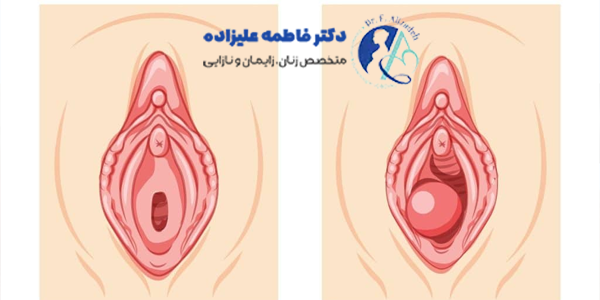 کیست بارتولن در زنان